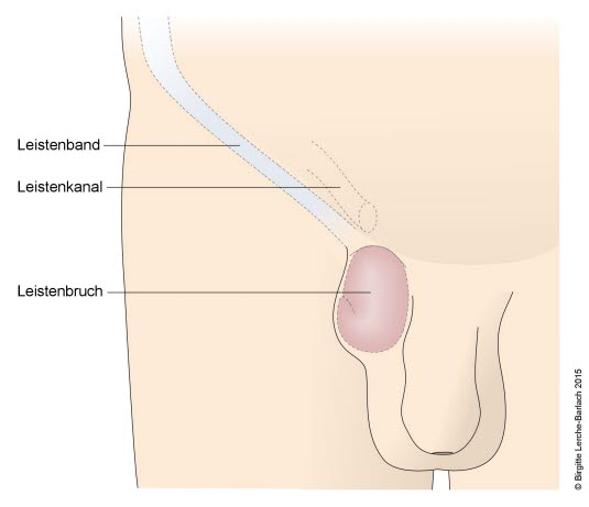 Leistenbruch