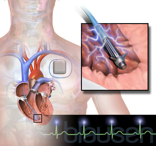 ICD: implantierbarer Kardioverter-Defibrillator