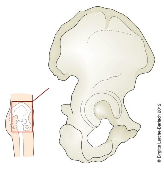 Ileum mit Azetabulum