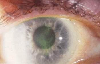 1246-2-keratitis-herpes-simplex-bilde-2.jpg