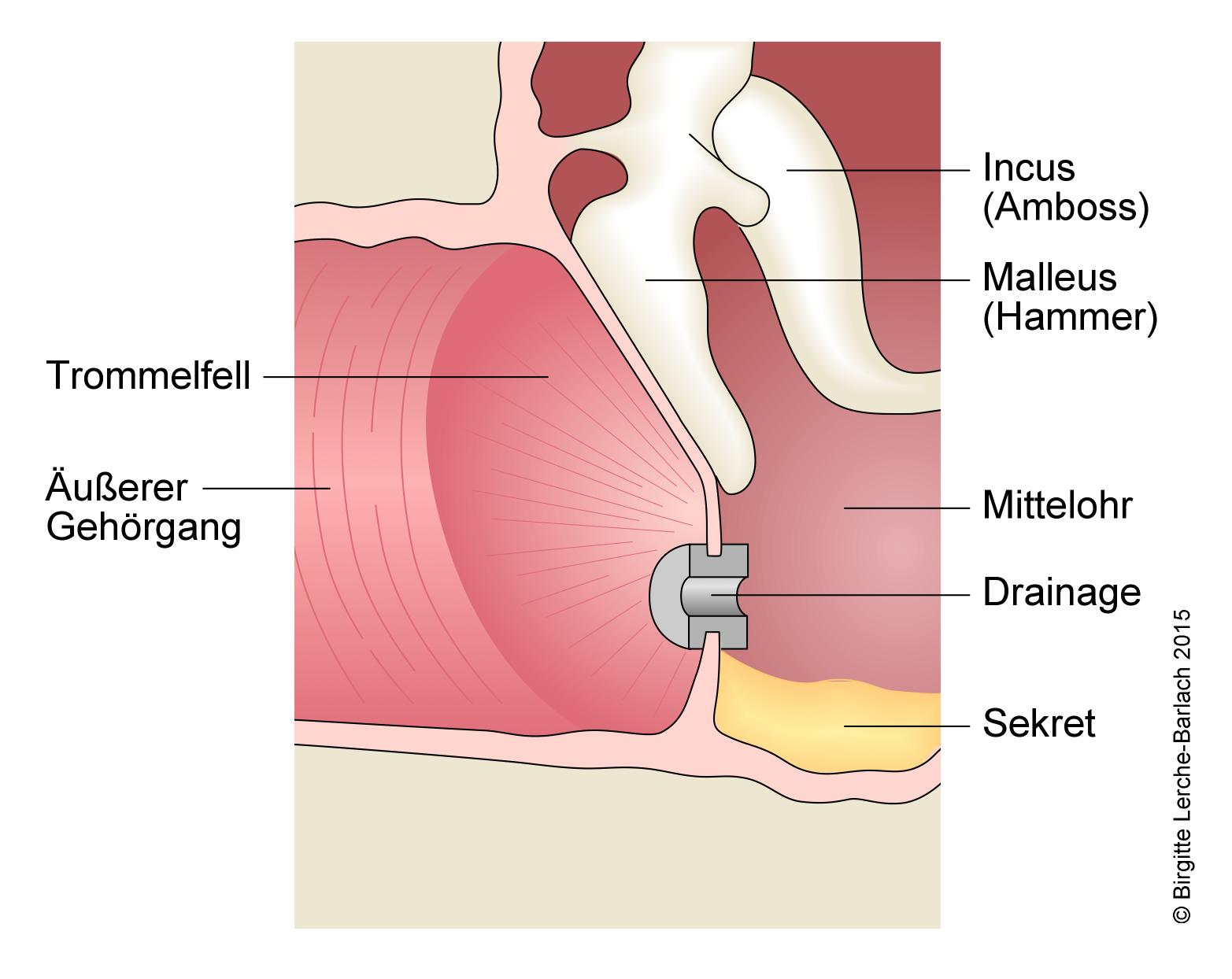 Trommelfell mit Drainage Querschnitt.jpg