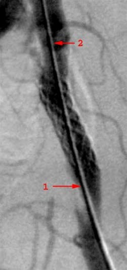 Die rote Markierung kennzeichnet eine Arterienstenose, die mit einem Stent (1) behandelt wurde. (2) zeigt den Katheter.