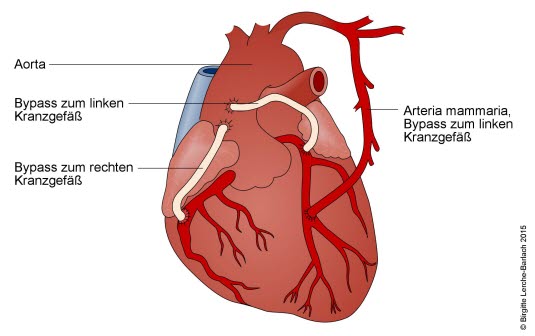 Koronarer Dreifach-Bypass