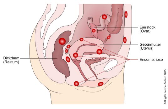 Endometriose, verschiedene Lokalisationen