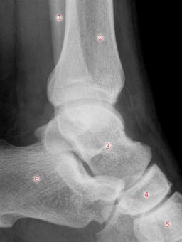 Sprunggelenk von der lateralen Seite: 1. Fibula (Wadenbein), 2. Tibia (Schienbein), 3. Talus (Sprungbein), 4. Os naviculare (Kahnbein), 5. Os cuneiforme (Keilbein), 6. Kalkaneus (Fersenbein)