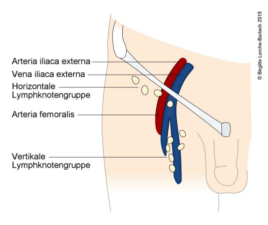 Lymphknoten in der Leistenregion