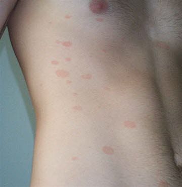 Pityriasis rosea: Stammbetontes Exanthem aus kleineren, schuppenden Erythemen wenige Wochen nach Primärmedaillon 