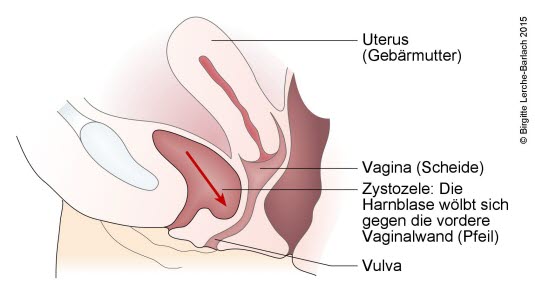 Zystozele