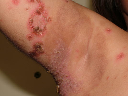 Impetigo contagiosa