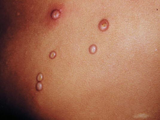 Die Inkubationszeit von der Infektion mit dem Molluscum-contagiosum-Virus bis zum Ausbruch reicht von 2 Wochen bis zu 6 Monaten. Die meisten Läsionen bilden sich innerhalb von 6 bis 9 Monaten spontan zurück, können aber auch wesentlich länger bestehen bleiben.