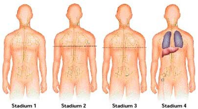 Lymphom-Staging (Information zu den einzelnen Stadien)