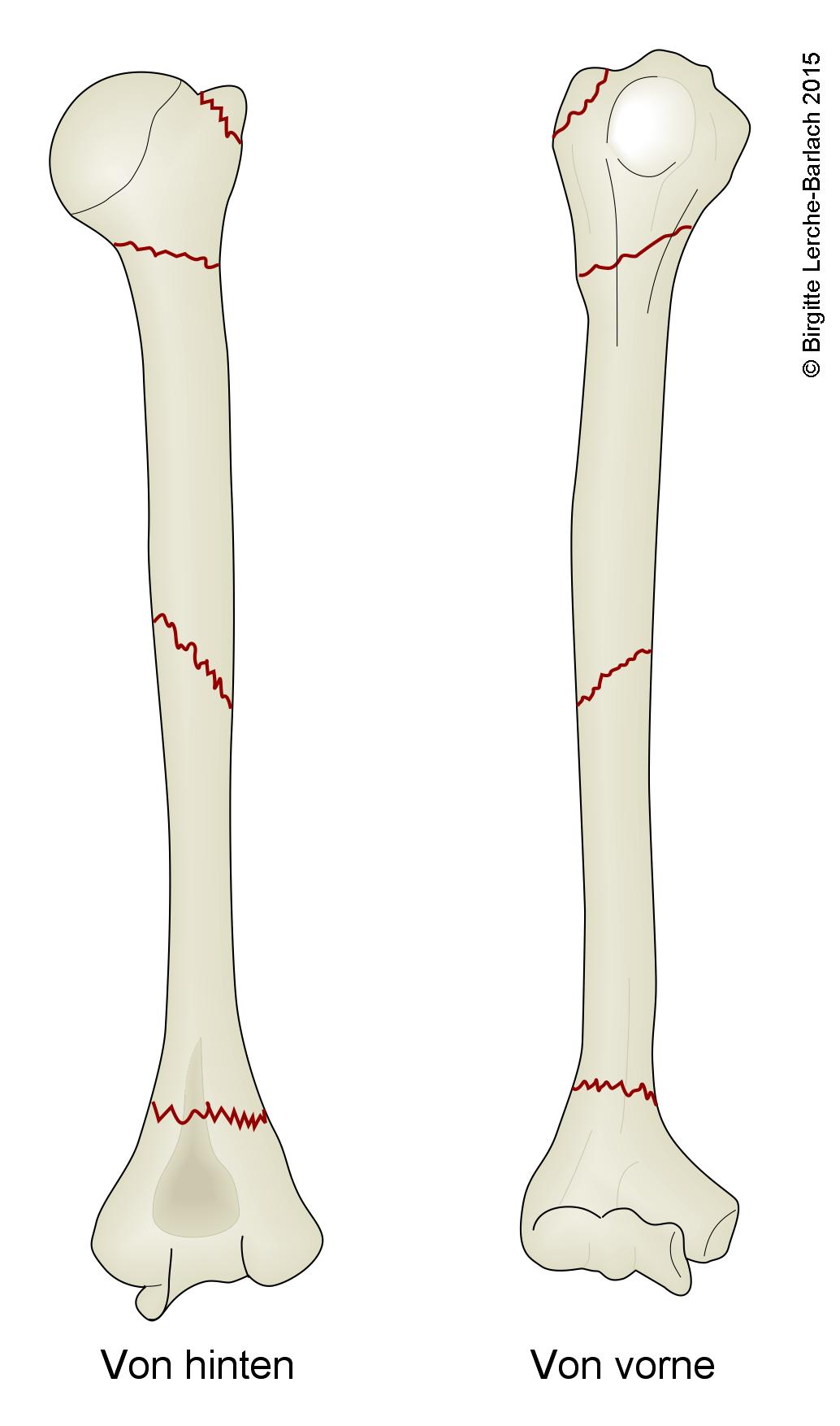 Humerus, häufigste Frakturlokalisationen