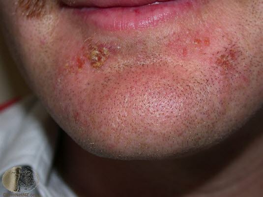 Impetigo