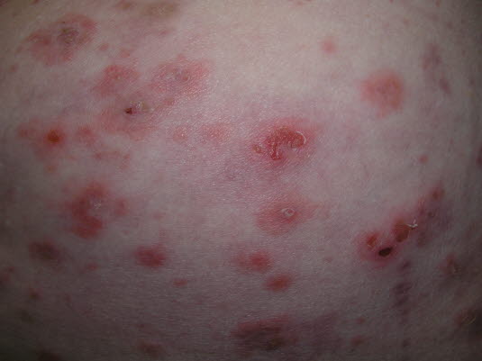 Bullöses Pemphigoid