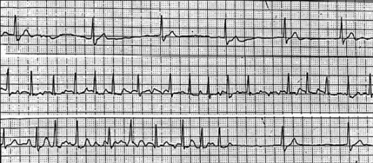 Beispiel von EKG-Veränderungen beim Sick-Sinus-Syndrom