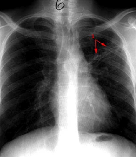 Primärtuberkulose, behandelt