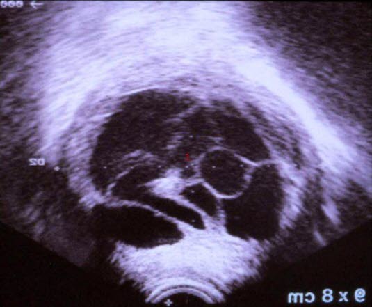 Komplexe Zyste: Degeneratives Myom, Ultraschall