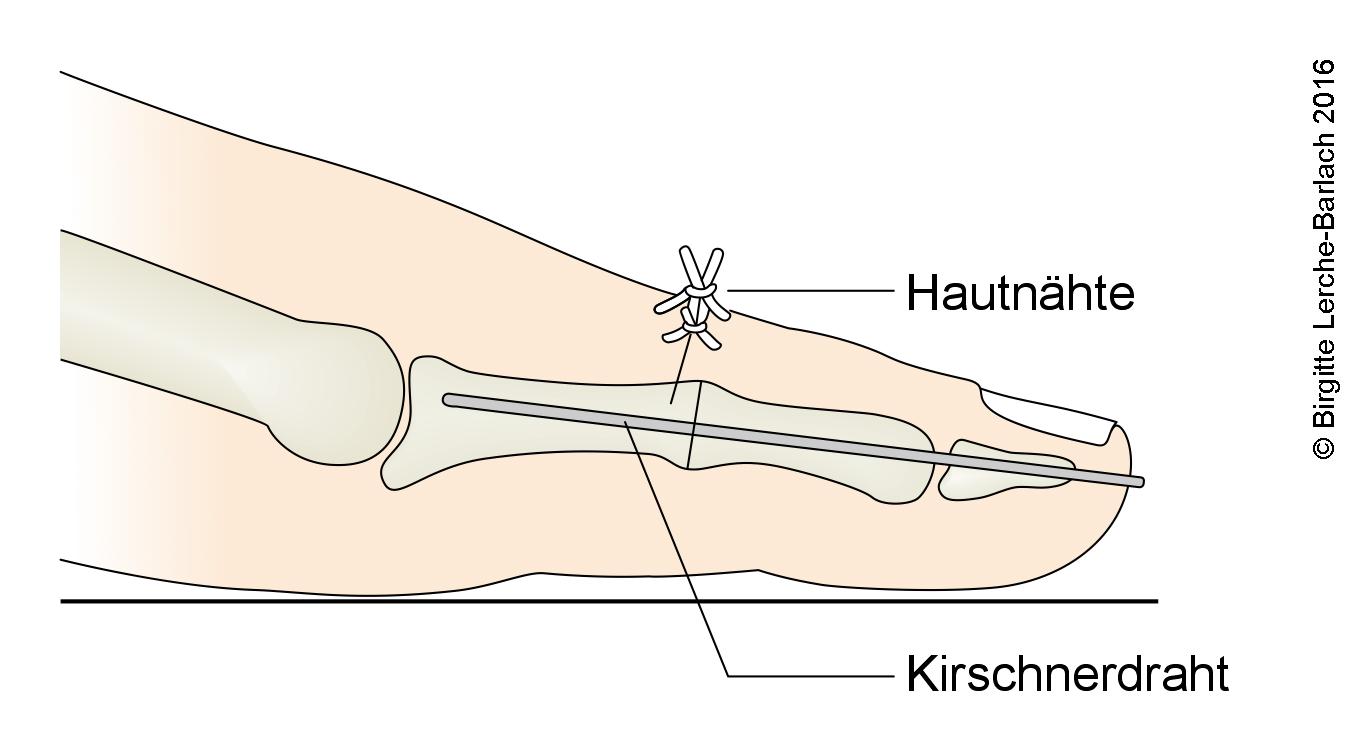 Hammerzehe nach einer Operation