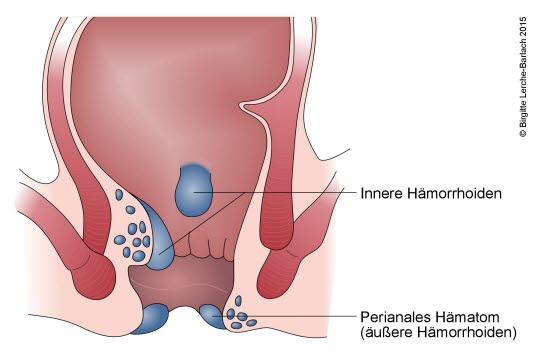 Hämorrhoiden