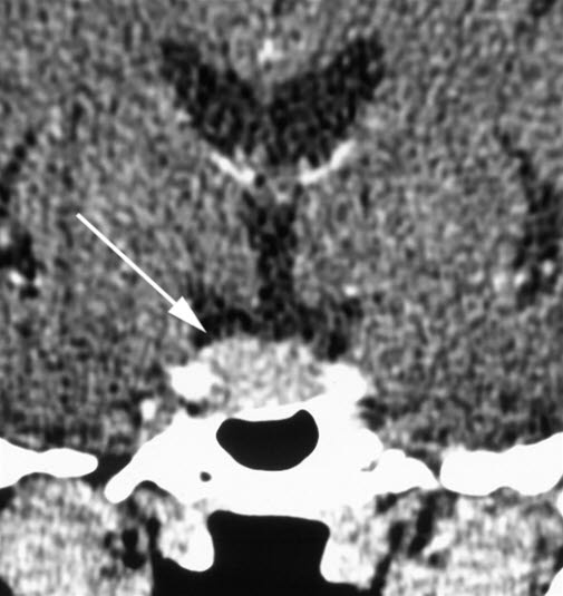 Hypophysentumor (CT)