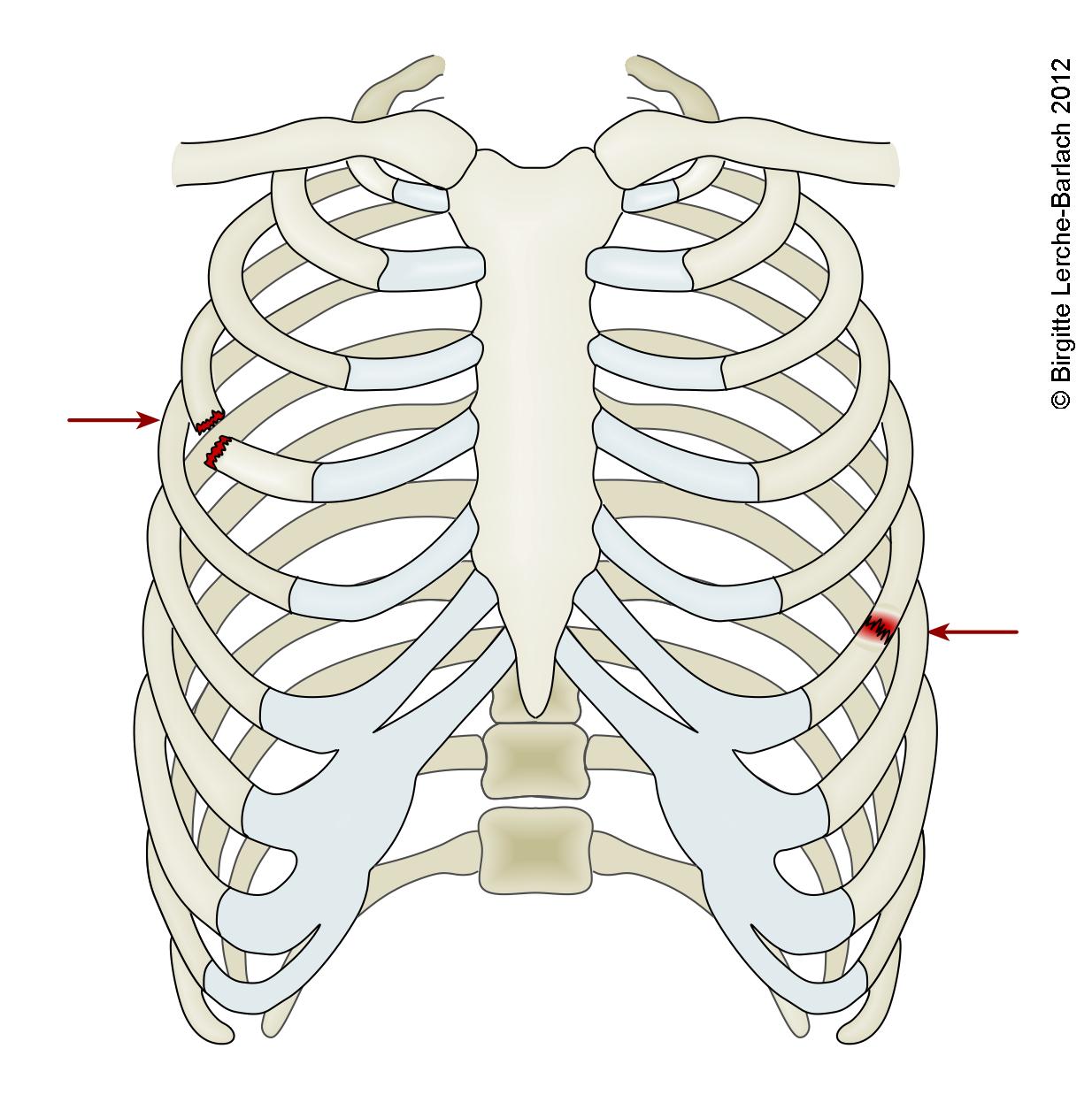 Rippenfraktur.jpg