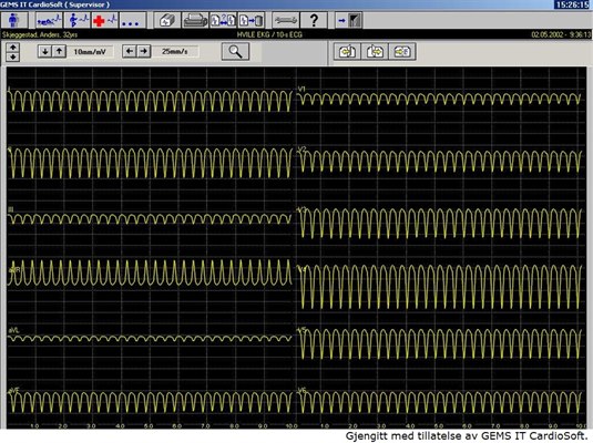 Ventrikuläre Tachykardie, EKG