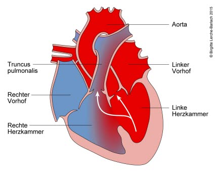 681-ventrikelseptumdefekt-vsd.jpg