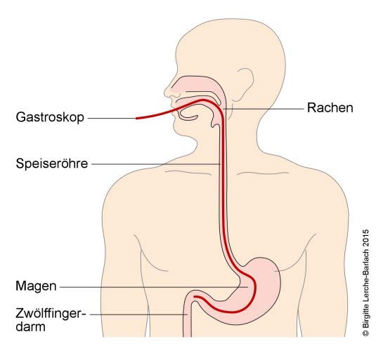 Gastroskopie