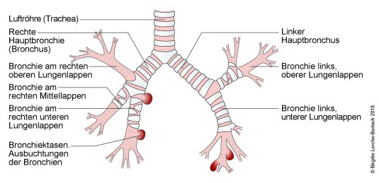 Bronchiektasen