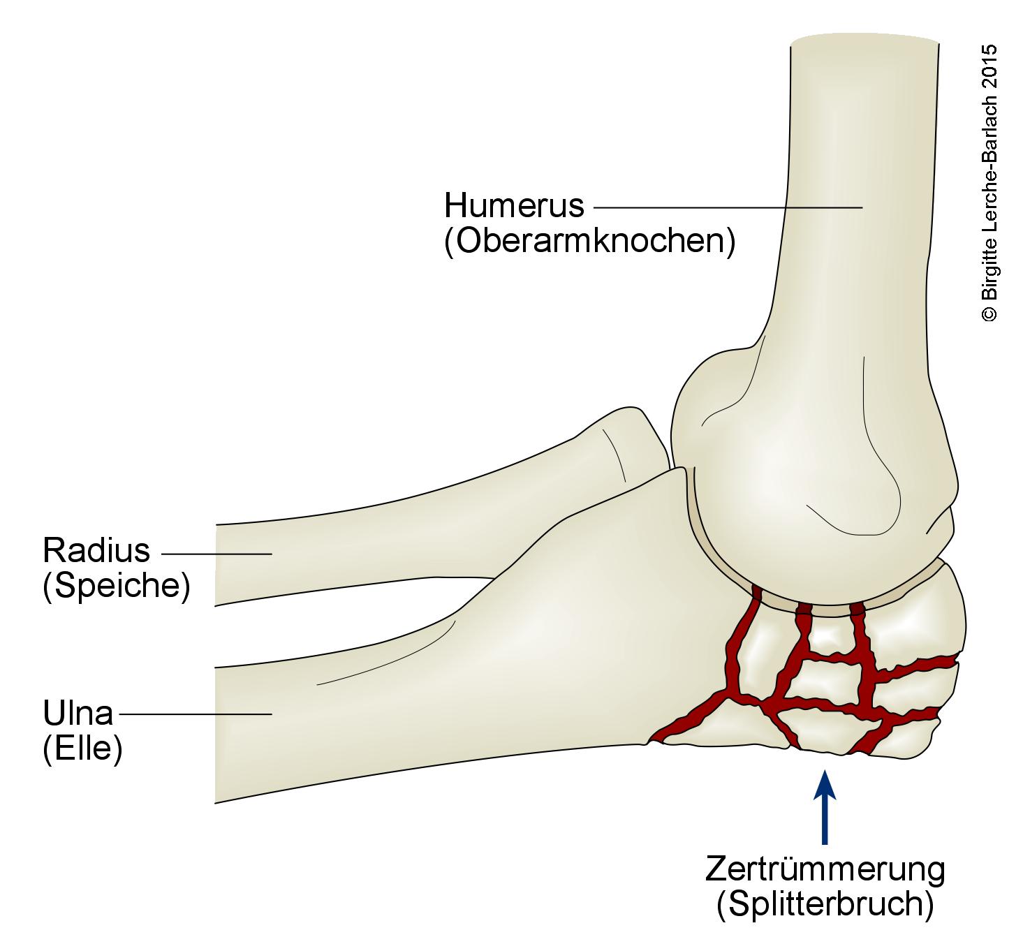 Ulna, Splitterbruch