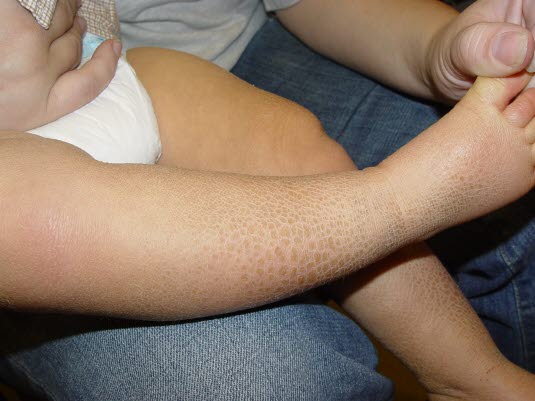 Ichthyosis vulgaris