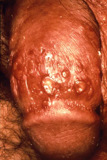 Herpes genitalis, Mann