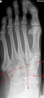 A.-p.-Aufnahme eines normalen Fußes: (1) Os cuboideum (Würfelbein), (2) Phalanx media, (3) Os cuneiforme intermedium (mittleres Keilbein), (4) Os metatarsale II, (5) Os naviculare (Kahnbein).