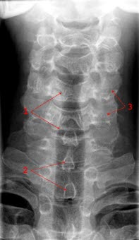 Normale Frontansicht der zervikalen Wirbelsäule: 1. Trachea, 2. Processi spinosi (Dornfortsätze), 3. Prosessi transversi (Querfortsätze)