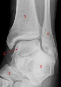 Schrägaufnahme Sprunggelenk: 1. Os naviculare (Kahnbein), 2. Talus (Sprungbein), 3. Tibia (Schienbein), 4. Fibula (Wadenbein), 5. Kalkaneus (Fersenbein)