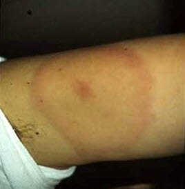 Erythema migrans