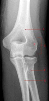 Normales Ellenbogengelenk, von vorn: 1. Humerus (Oberarmknochen), 2. Epicondylus lateralis, 3. Condylus lateralis, 4. Radius (Speiche), 5. Ulna (Elle)