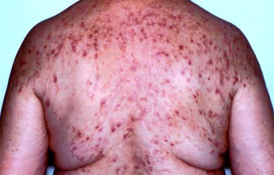 Dermatitis herpetiformis. Juckenden Papeln, Vesikeln, Papulovesikeln und Bullae, die individuell sehr unterschiedlich ausgeprägt sein können. Prädilektionsstellen sind Ellenbogen, Knie, Gesäß, Hals und Kopfhaut.