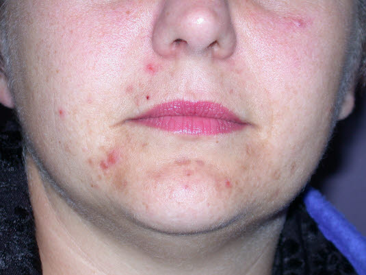 Acne excoriée