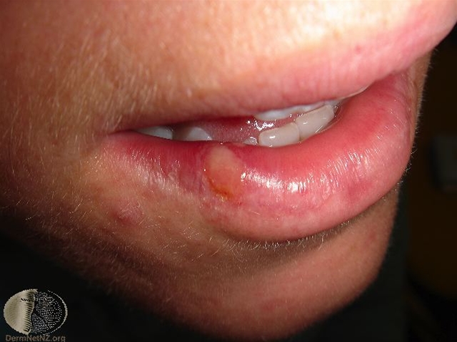 4061-2-herpes-simplex-labialis-1.jpg