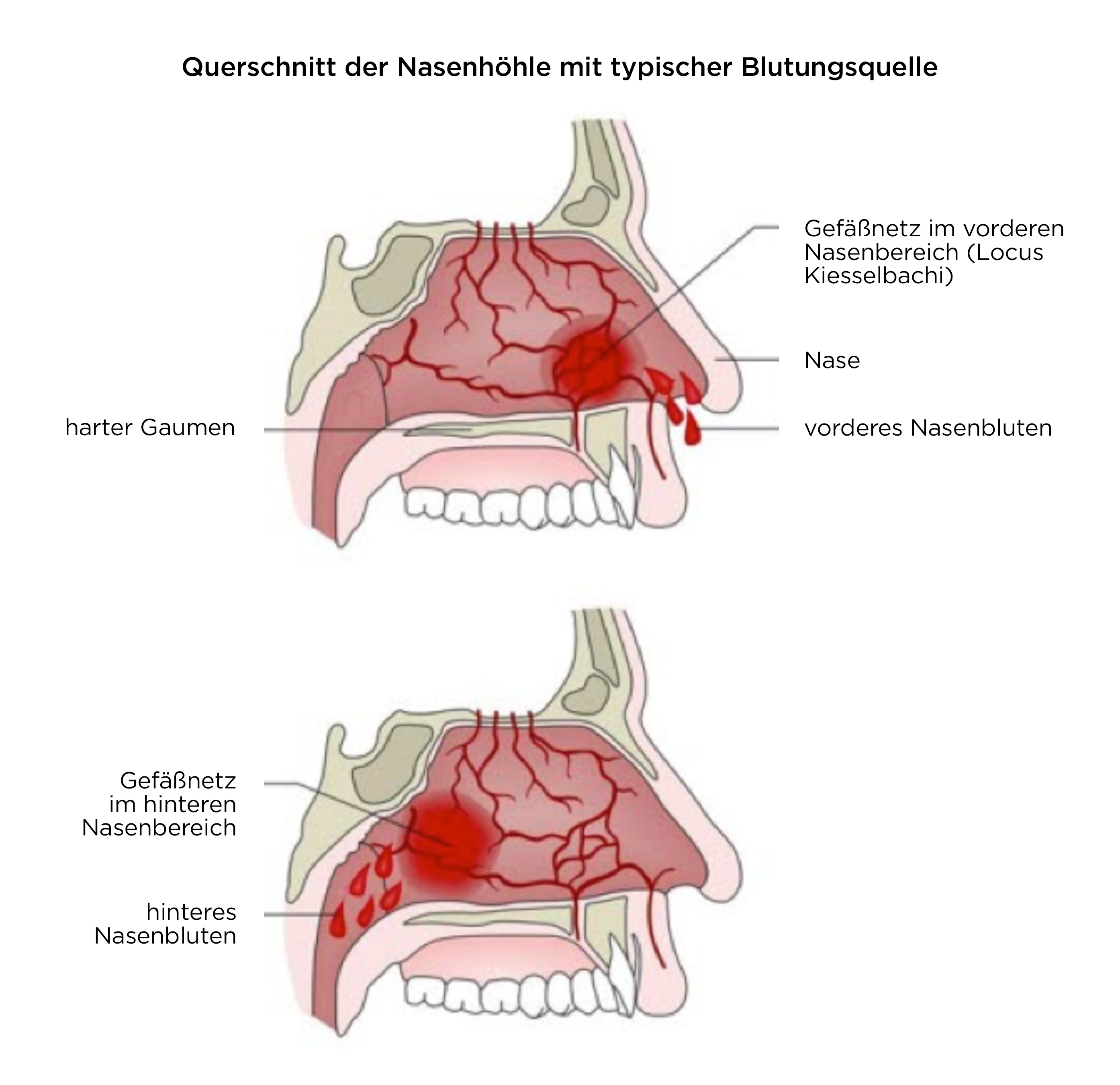 Querschnitt der Nasenhöhle mit typischer Blutungsquelle